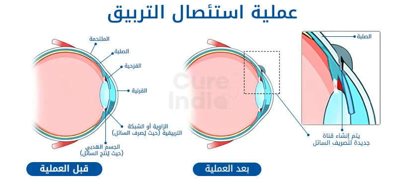 علاج المياه الزرقاء في العين من الهند